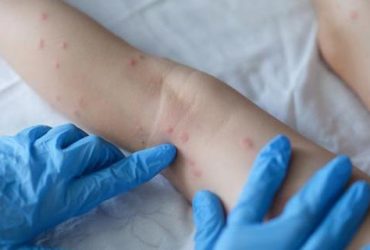 Brasil registra terceiro caso de varíola dos macacos
