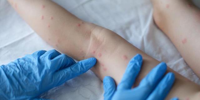 Brasil registra terceiro caso de varíola dos macacos
