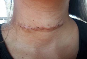 Mulher é ferida por linha com cerol no pescoço enquanto dirigia moto no interior do Piauí
