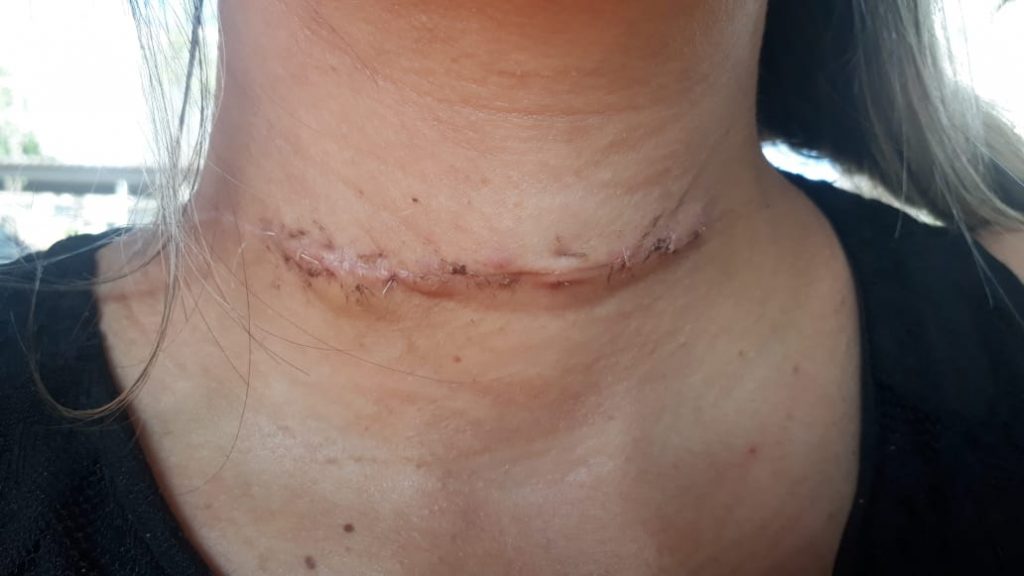 Mulher é ferida por linha com cerol no pescoço enquanto dirigia moto no interior do Piauí