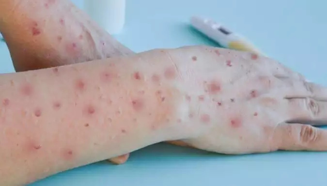 Ministério da Saúde lança campanha sobre a varíola dos macacos
