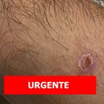 3º caso de varíola dos macacos e confirmado no Piauí
