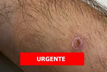 3º caso de varíola dos macacos e confirmado no Piauí