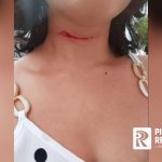 Mulher tem corte no pescoço ao ser atingida por linha de cerol no interior do Piauí