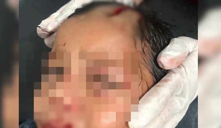 Criança de 2 anos é atacada por cachorra no interior do Piauí