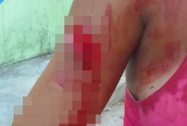 Briga entre mulheres deixa pessoa gravemente ferida a golpes de faca e madeirada no interior do Piauí