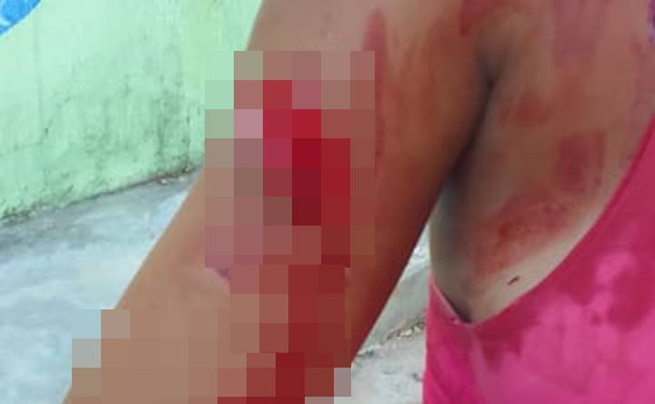 Briga entre mulheres deixa pessoa gravemente ferida a golpes de faca e madeirada no interior do Piauí