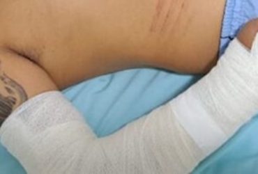 Árbitro sofre agressão física e tem braço quebrado durante jogo no Piauí