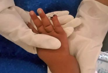 Enfermeira amputa acidentalmente dedo de bebê