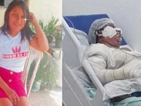 Mulher sofre graves queimaduras ao utilizar álcool para acender fogo em Piripiri