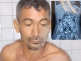 Médicos encontram parafusos dentro de criança que foi violentada pelo pai no Piauí
