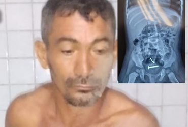 Médicos encontram parafusos dentro de criança que foi violentada pelo pai no Piauí