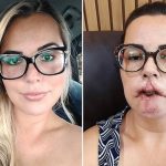 Influenciadora perde lábios 6 meses depois de harmonização facial