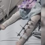 Criança é operada e recebe 6 pinos na perna errada na Paraíba