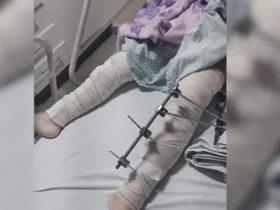Criança é operada e recebe 6 pinos na perna errada na Paraíba