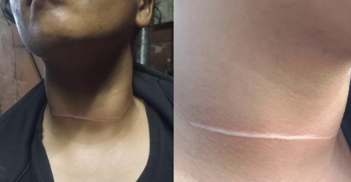 Jovem é ferida após ser atingida por linha de cerol no pescoço no interior do Piauí