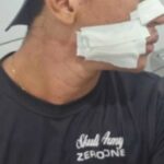 Jovem fica com rosto ferido após ser atingido por linha de cerol no Piauí